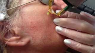 Laser treatment for facial thread veins with Candela NdYag laser [upl. by Zeeba192]