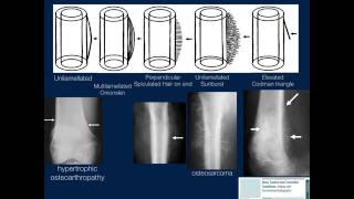 Bone Lesions Radiographic Assessment Part 1 by Geoffrey Riley MD [upl. by Koosis]