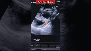 Anomaly Scan Anencephaly ❤️💯 medical anomaly ultrasound pregnancy shorts [upl. by Kezer]