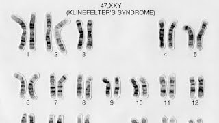 KARYOTYPE amp SYMPTOMS OF KLIENFELTERS SYNDROME [upl. by Enirroc]