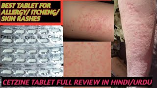 BEST TABLET FOR ALLERGY AND SKIN RASHES AND ITCHINGCETZINE TABLET FULL REVIEW IN HINDIURDU [upl. by Ietta]