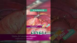 By Pass Gástrico  Tratamiento de la Obesidad Diabetes e Hipertensión  610 [upl. by Esital]