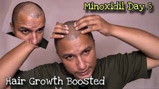 Using Minoxidil Day 5 Update  How to Apply  Hair Growth Thickness amp Texture Changes  Hindi [upl. by Aztilem]