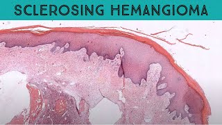 Polypoid Dermatofibroma aneurysmal type aka sclerosing quothemangioma” pathology dermatology [upl. by Hedvige125]