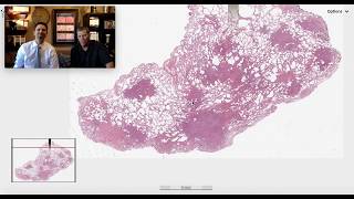 Pattern 5  Nodular Pulmonary Langerhans Cell Histiocytosis [upl. by Aelrac]