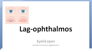 Ophthalmology 387 a LagOphthalmos Eyelid open eye Causes Treatment Sleeping with Eye open [upl. by Noloc]