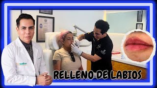 EMBELLECIMIENTO de LABIOS con ÁCIDO HIALURÓNICO I JAVIER DERMA [upl. by Hsirap]