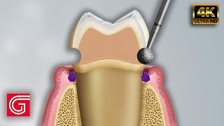 Tooth extraction  Treatment for socket preservation © [upl. by Erdua]