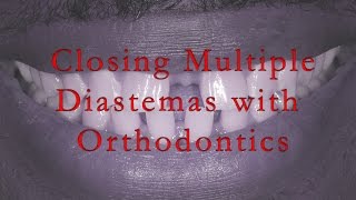 Closing Multiple Diastemas With Orthodontics [upl. by Denise540]