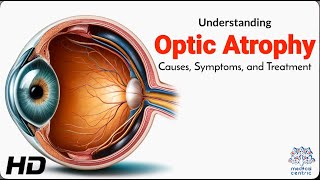 Optic Atrophy Explained Causes Symptoms and Treatment Options [upl. by Trainor]