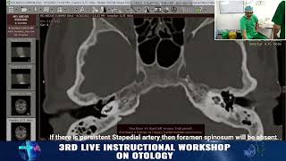 Preoperative CT scan in Otosclerosis Points to consider Prof Dr Delwar Hossain [upl. by Imarej]