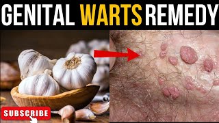 NATURALLY REMOVE GENITAL WARTS WITH GARLICgenitalwarts wartstreatment naturalremedy [upl. by Arammahs]