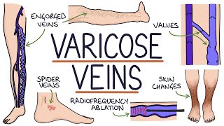 Understanding Varicose Veins [upl. by Belia]