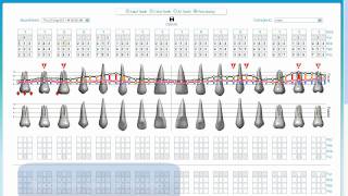 Periodontal Charting [upl. by Wilkins]