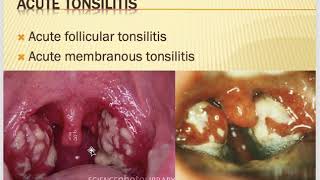 Tonsillitis Tonsillectomy adenoidectomy and Quinsy [upl. by Blondell]