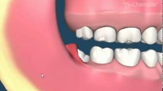 Impacted Wisdom Teeth Removal Animation [upl. by Niwhsa860]