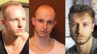 My Hair Loss Story amp Going Bald at a Young Age Prevention Tips Video Footage [upl. by Eniluj564]