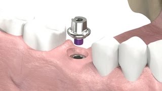 SIC invent Dental Implant  Prosthetic Animation Single Crown Closed Tray Technique [upl. by Eltsyrk]