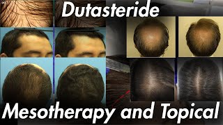 Dutasteride Topical and Mesotherapy IT WORKS [upl. by Avehsile98]