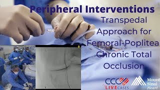 Transpedal Approach for FemoralPopliteal Chronic Total Occlusion [upl. by Cate]