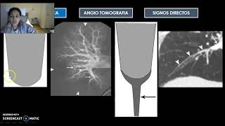 Tromboembolia Pulmonar TEP [upl. by Rossuck]