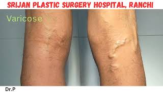 Foam Sclerotherapy treatment for varicose veins  Varicose veins treatment for SSC GD medical [upl. by Adne]