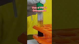 Uses of PRP in orthopaedics prp prptherapy prptreatment kneeosteoarthritis kneepainrelief [upl. by Flemings]