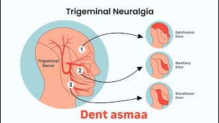 شرح trigeminal neuralgia [upl. by Amri]