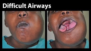 VividTrac  Nasal Intubation Difficult Airway [upl. by Niarda621]