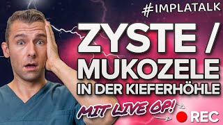 Zyste  Mukozele in der Kieferhöhle 🆘 Was tun Wir erklären die Ursachen amp Therapie inkl Live OP [upl. by Akoyn759]