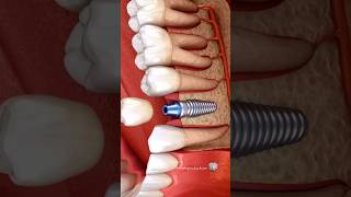 Имплантация зубов 🤍 implants implants dentist [upl. by Pitzer]