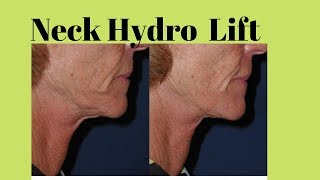 Skin Booster on Neck Lift using Restylane Vital Light for ageing neck [upl. by Haden]