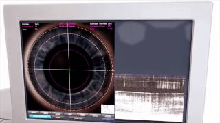 Femto second laser cataract animated video [upl. by Neenaj594]