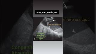 Hematocolpos ampHematometrocolpos  abdomen baby pregnant doctor pregnancyjourney motivation [upl. by Penrod]