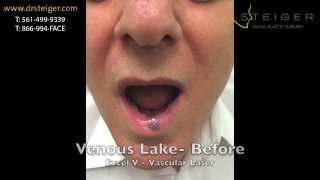 Laser of a Venous Lake on the Lip  Excel V [upl. by Skantze]