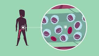 CLL  Wat is Chronische Lymfatische Leukemie [upl. by Kutzenco398]