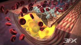 DiabetesRelated Atherosclerosis [upl. by Larissa]