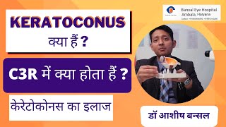 What is Keratoconus amp C3R Corneal Cross Linking Treatment  केरेटोकोनस का इलाज In Hindi [upl. by Ormiston496]