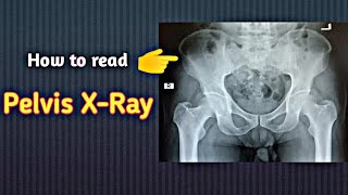 How to read a Pelvis XRay । Pelvis का एक्स रे कैसे पढ़े । Uday Xray [upl. by Glassman950]