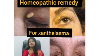 Homeopathic treatment for xanthelasmaPermanent treatment cost effective solution [upl. by Ankeny465]