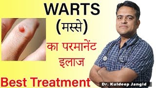 WARTS Best Treatment  मस्से का परमानेंट इलाज  Warts Homeopathic Treatment [upl. by Nimrak395]