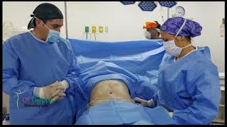 Cirugía Abdominal Abdominoplastia con Lipoescultura [upl. by Nnasus948]