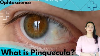 What is Pinguecula symptoms causes and treatment [upl. by Prima]