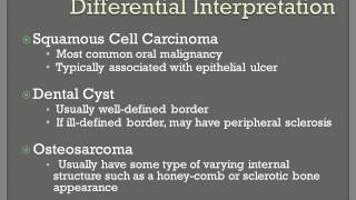 Fibrosarcoma [upl. by Ignacia]