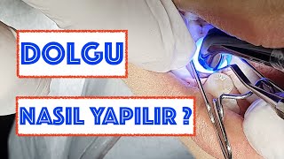 Dolgu Nasıl Yapılır [upl. by Hajidahk]