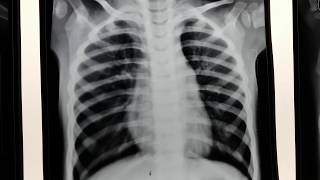 Hyperinflated chest x ray [upl. by Hamel]