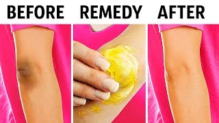 10 Natural Tricks to Remove Dark Knees and Elbows [upl. by Ynove]