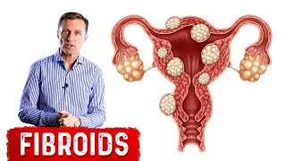 The Best Foods to Shrink Fibroids [upl. by Ydollem]