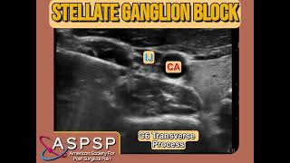 Ultrasound Guided Stellate Ganglion Block [upl. by Pufahl]