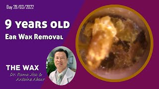 9 Years Old Ear Wax Removal and Cleaning 241 [upl. by Lleda]